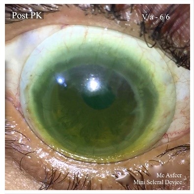 Boston Sight Scleral Lenses - Samyak